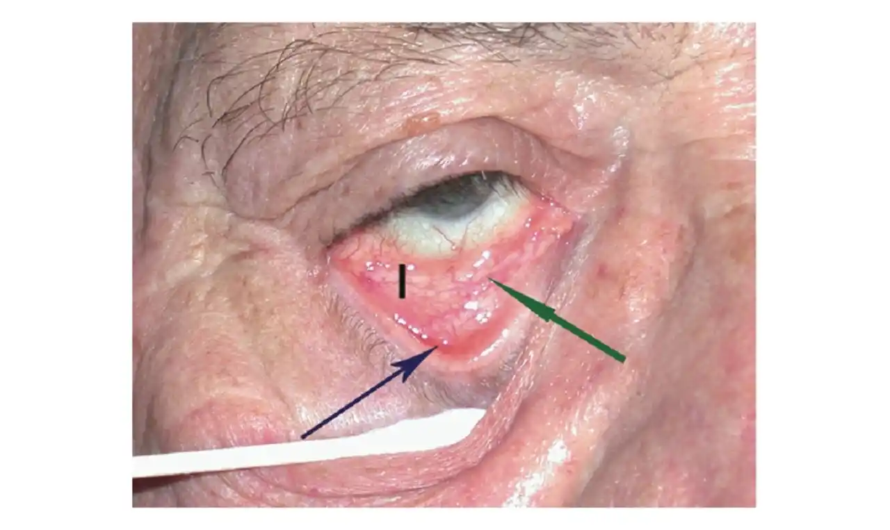 Entropion  Symptoms, Causes , Diagnosis and Unknown Facts