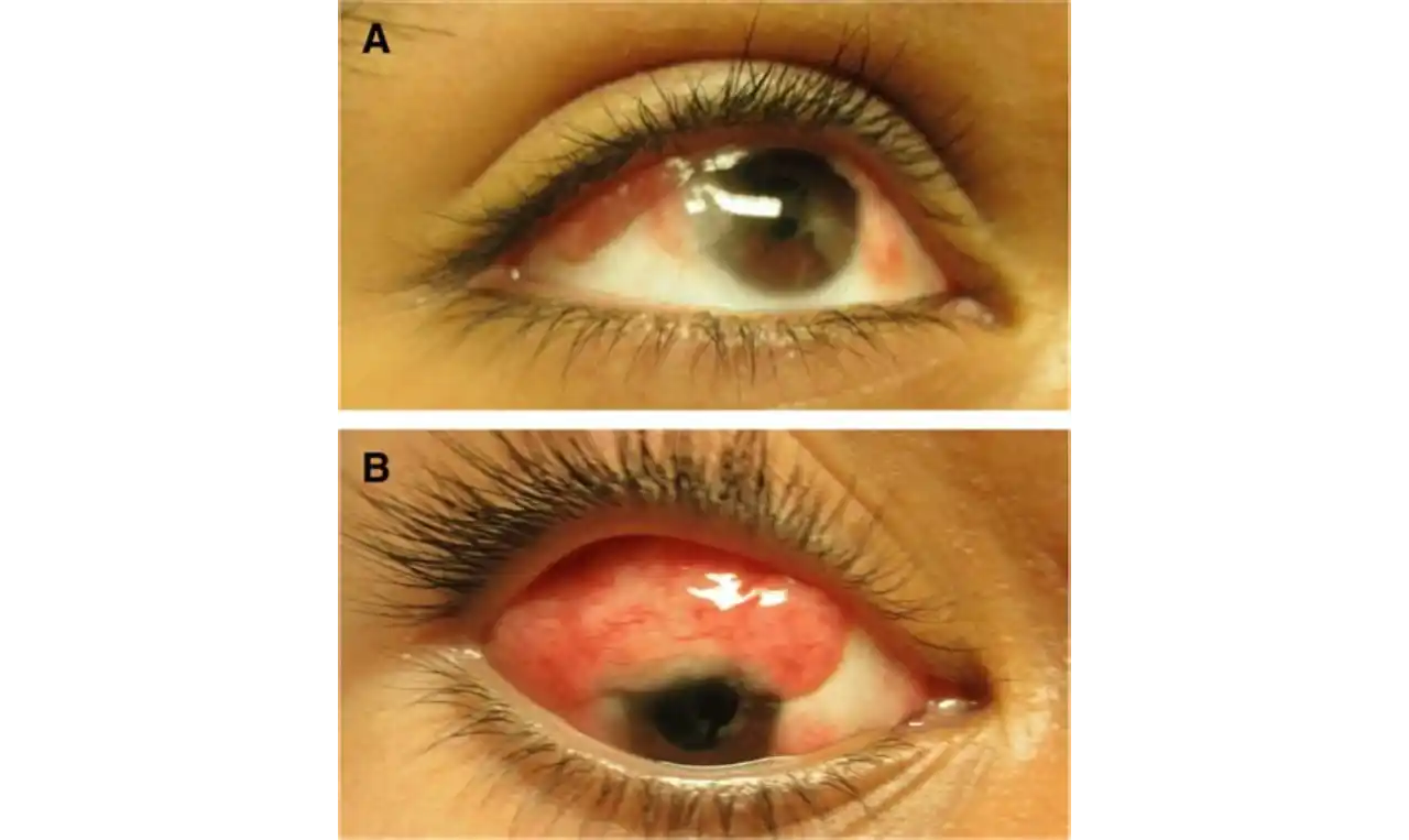 Epibulbar Dermoids Symptoms, Causes , Diagnosis and Unknown Facts