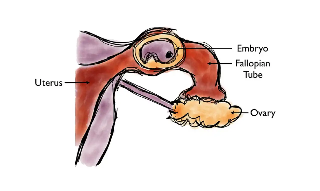 Ectopic pregnancy Symptoms, Causes , Diagnosis and Unknown Facts