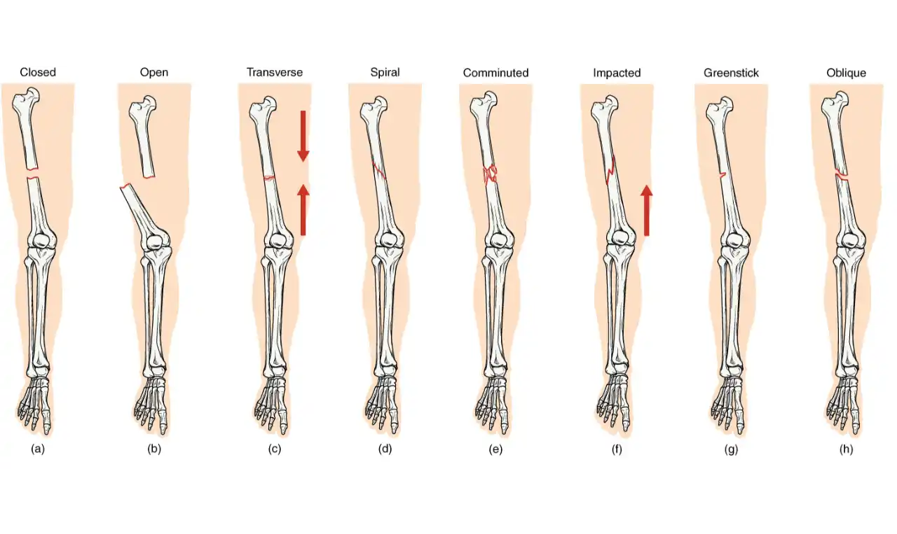 Fracture Symptoms, Causes , Diagnosis and Unknown Facts