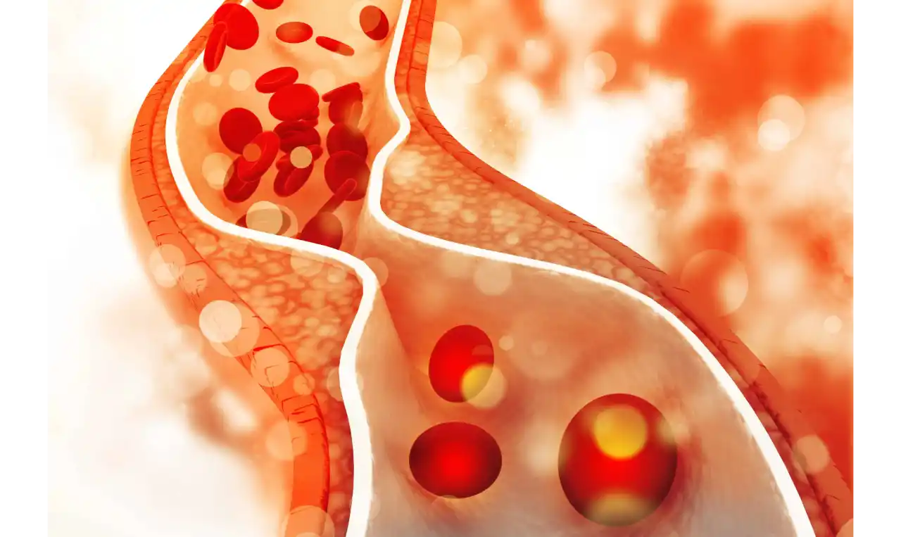 Atherosclerosis  Symptoms, Causes , Diagnosis and Unknown Facts