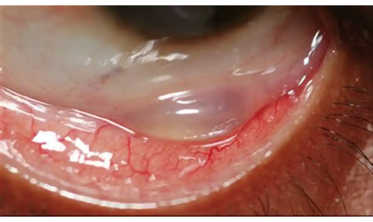 Inclusion Conjunctivitis   Symptoms, Causes , Diagnosis and Unknown Facts