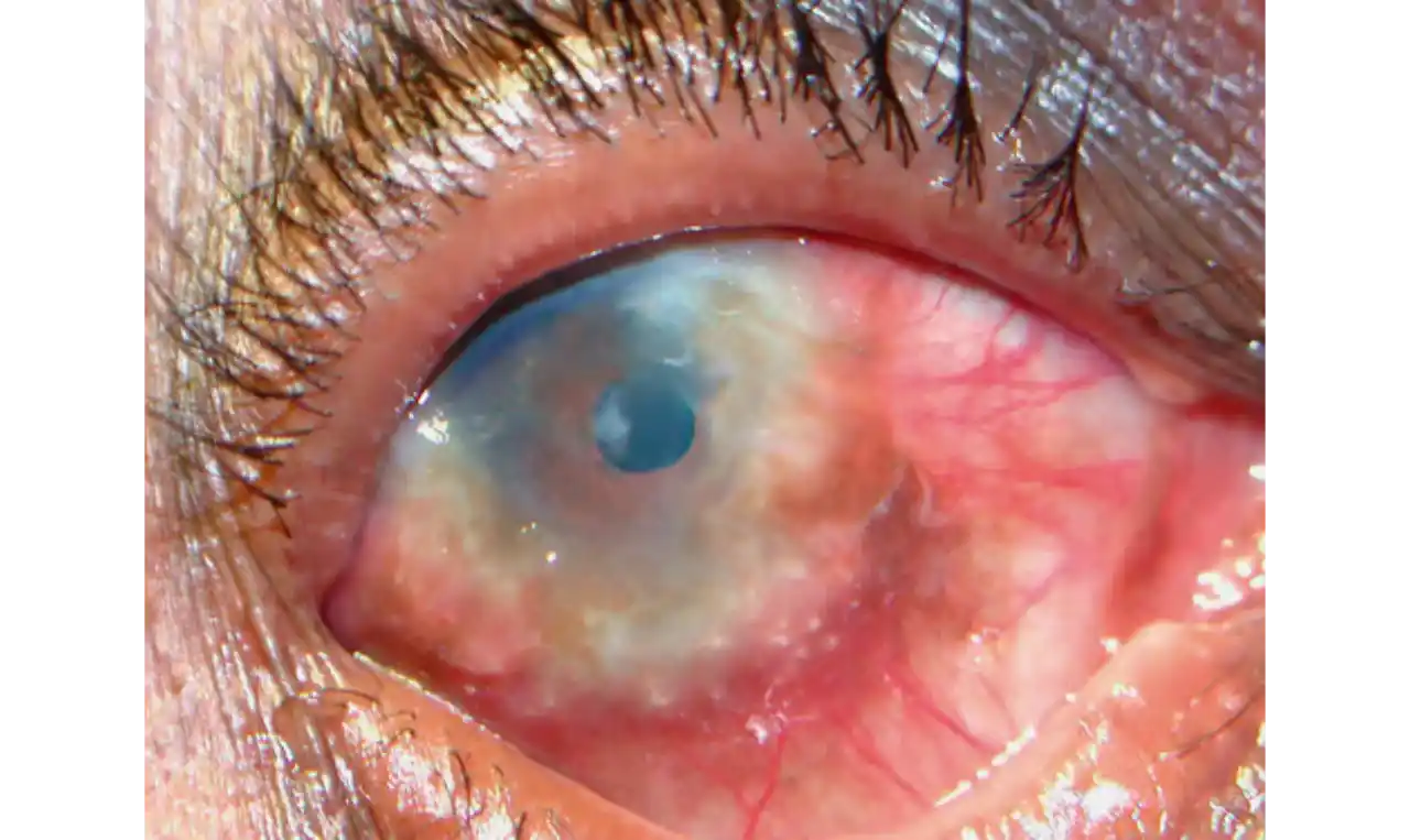 Atopic Keratoconjunctivitis   Symptoms, Causes , Diagnosis and Unknown Facts