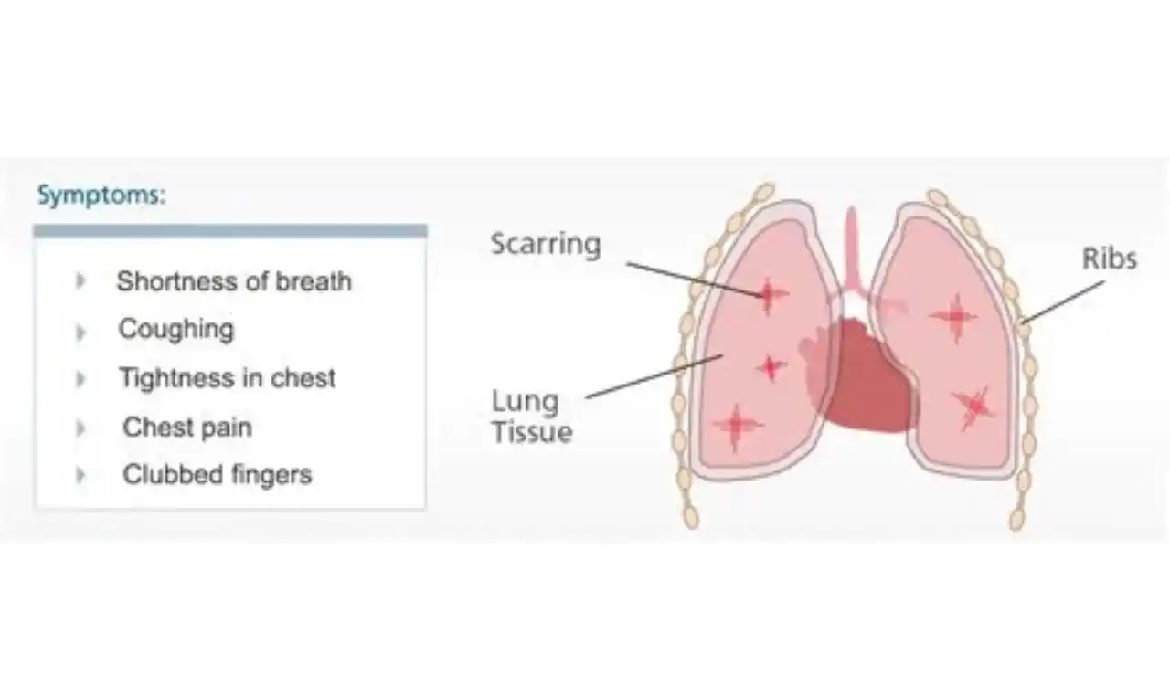 Asbestos diseases   Symptoms, Causes , Diagnosis and Unknown Facts