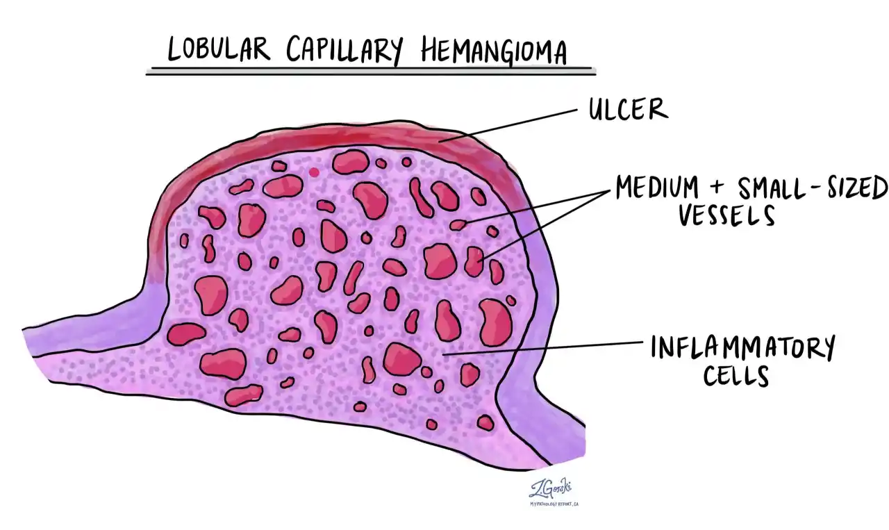 Acquired Capillary Haemangioma of Eyelid   Symptoms, Causes , Diagnosis and Unknown Facts