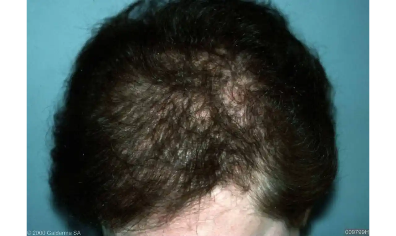 Alopecia (hair loss)   Symptoms, Causes , Diagnosis and Unknown Facts