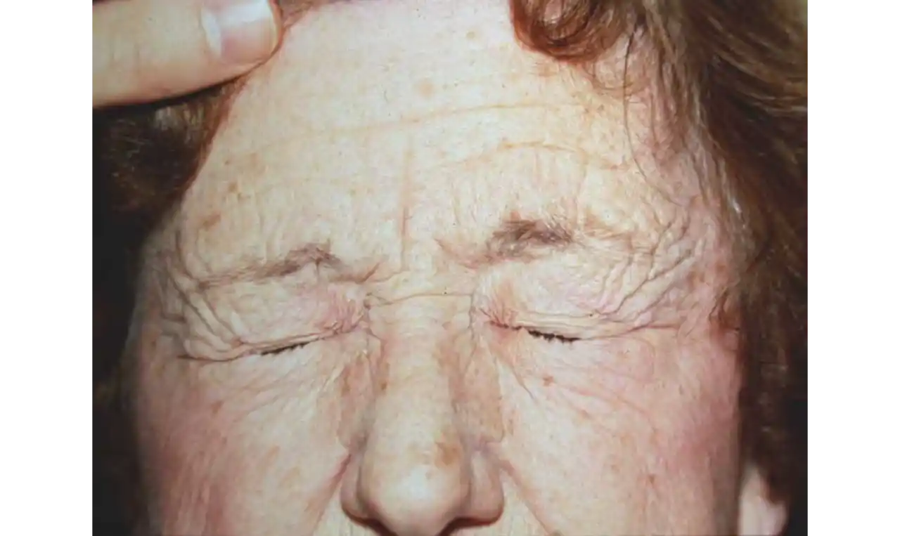 Benign Essential Blepharospasm  Symptoms, Causes , Diagnosis and Unknown Facts