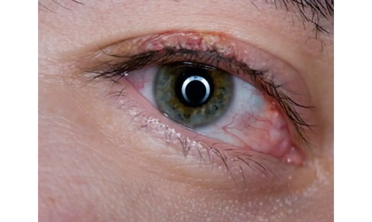 Blepharitis  Symptoms, Causes , Diagnosis and Unknown Facts