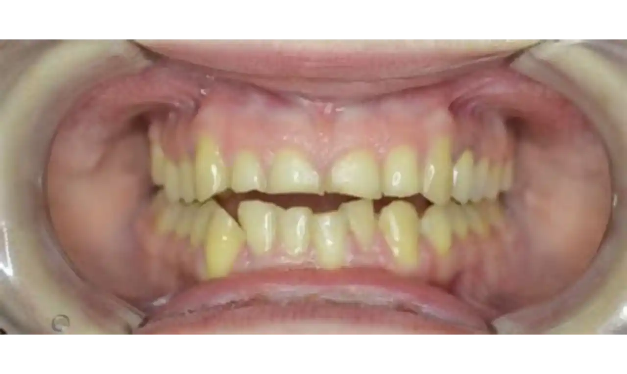 Bruxism  Symptoms, Causes , Diagnosis and Unknown Facts