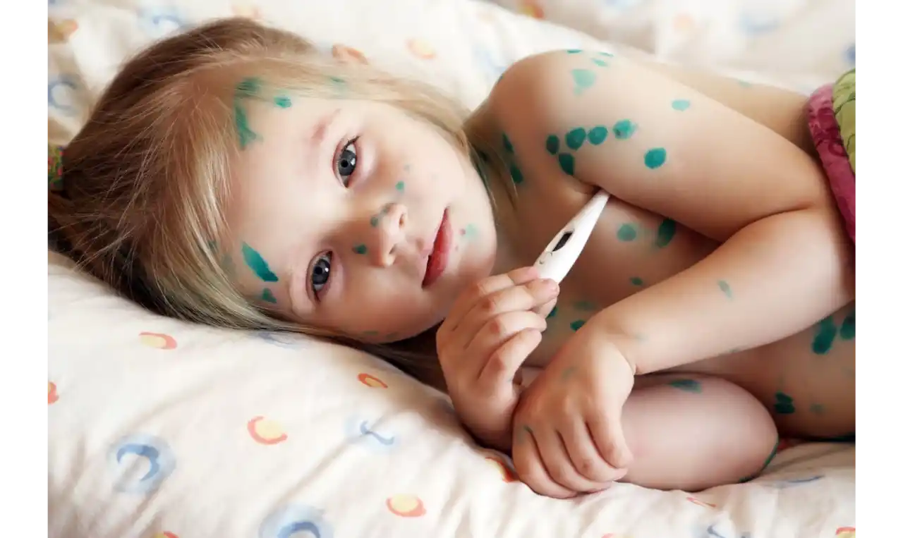 Chickenpox  Symptoms, Causes , Diagnosis and Unknown Facts