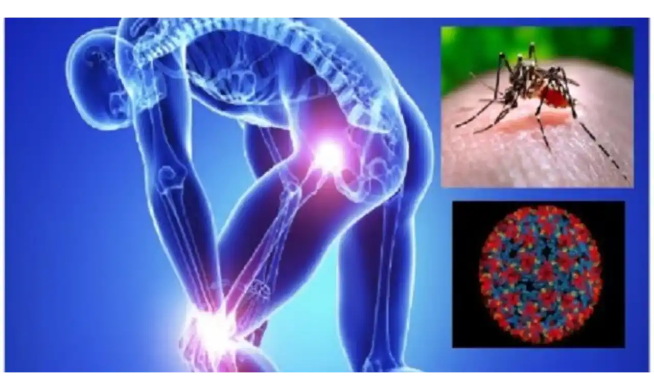 Chikungunya Fever   Symptoms, Causes , Diagnosis and Unknown Facts