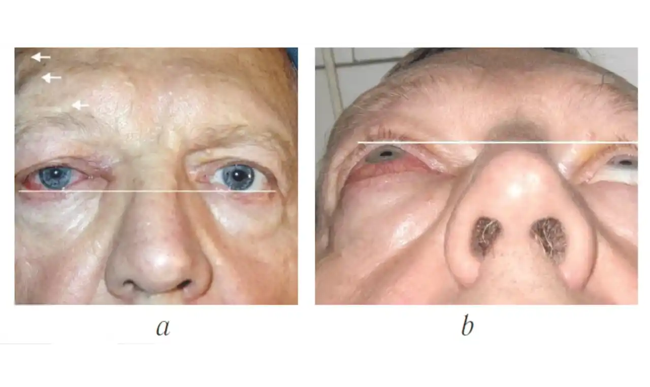 Cavernous Haemangioma of Eyelid   Symptoms, Causes , Diagnosis and Unknown Facts