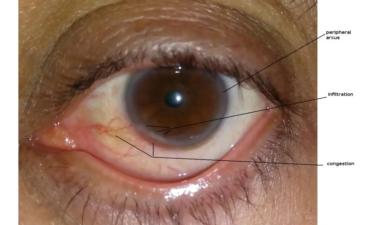 Corneal Abrasion Symptoms, Causes , Diagnosis and Unknown Facts