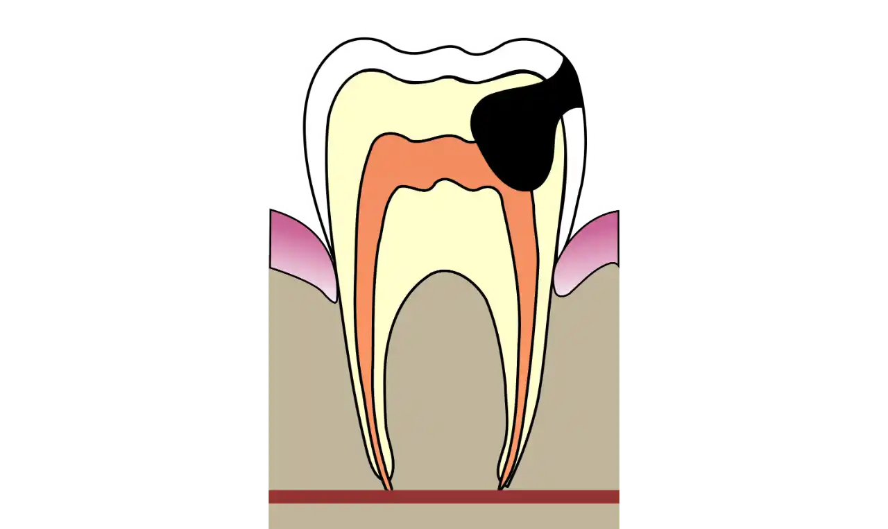 Cavities  Symptoms, Causes , Diagnosis and Unknown Facts