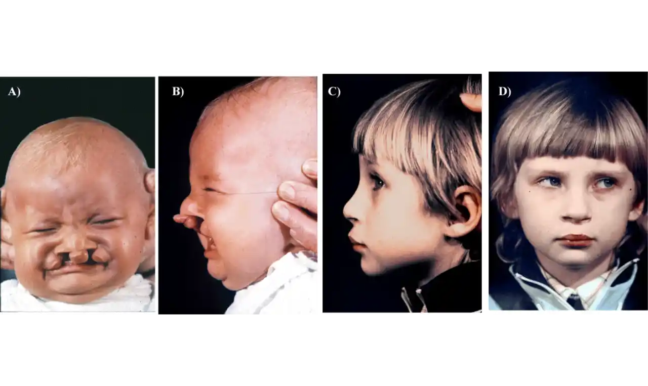 Cleft Lip and Cleft Palate   Symptoms, Causes , Diagnosis and Unknown Facts