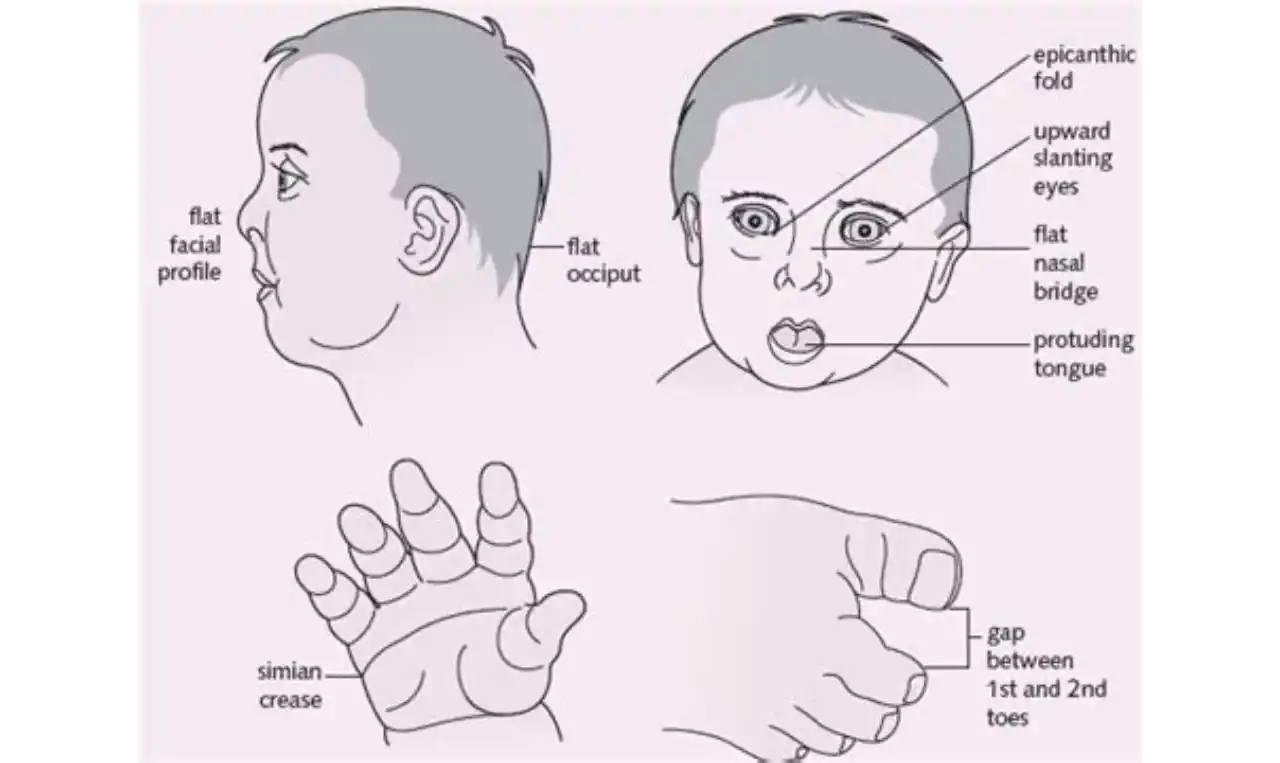 Down Syndrome   Symptoms, Causes , Diagnosis and Unknown Facts