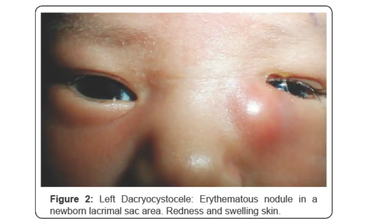 Dacryocystitis  Symptoms, Causes , Diagnosis and Unknown Facts