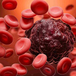 Unmasking Blood Cancer Symptoms on the Face
